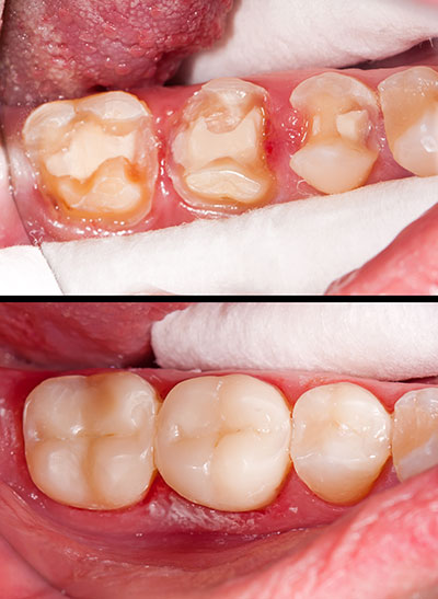 Buck Dental Health Associates | Implant Restorations, Dental Sealants and Pediatric Dentistry