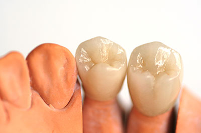 Buck Dental Health Associates | Inlays  amp  Onlays, Fluoride Treatment and Dental Bridges