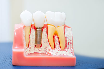 Buck Dental Health Associates | Oral Exams, Fluoride Treatment and Dental Fillings