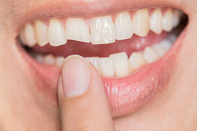 Buck Dental Health Associates | Veneers, Dental Bridges and Periodontal Treatment