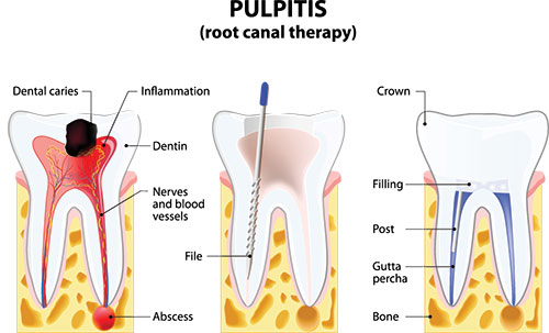 Buck Dental Health Associates | Crowns, All-on-4 reg  and Root Canals