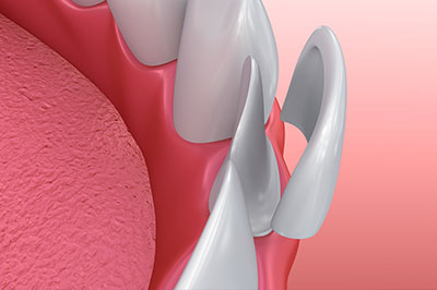 Buck Dental Health Associates | Dentures, All-on-4 reg  and Fluoride Treatment