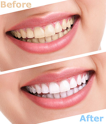 Buck Dental Health Associates | Implant Dentistry, Fluoride Treatment and Veneers